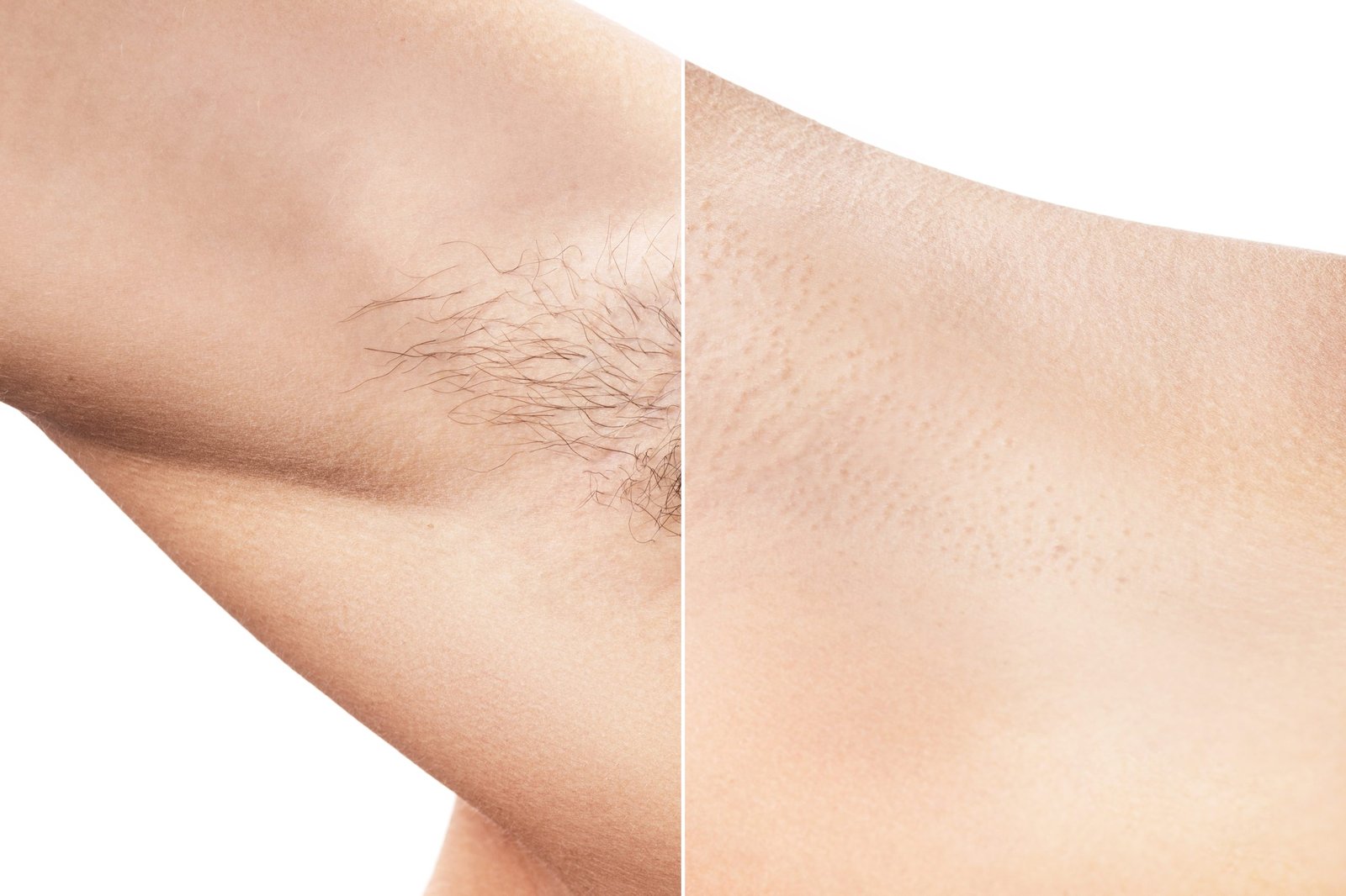 Comparison of female armpit after hair removal treatment
